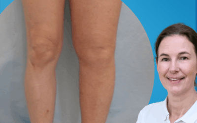 VESTITI E SCARPE STRINGONO? NON NECESSARIEMENTE TI SEI INGRASSATA!!! PUO’ ESSERE LINFEDEMA